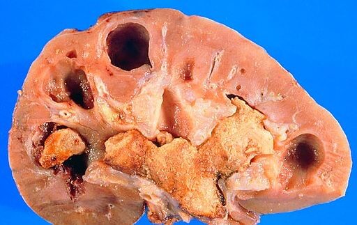 Calcoli renali — immagine medica