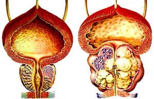 Adenoma della prostata — immagine medica