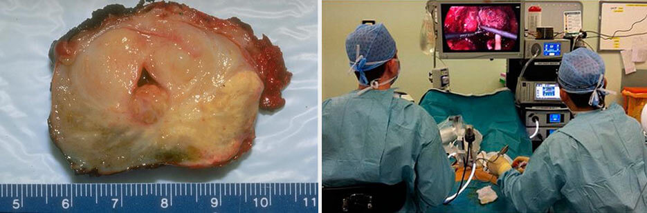 Cancro alla prostata — immagine medica